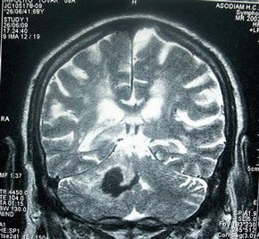 En la imagen, resonancia magnética nuclear de cráneo mostrando hemorragia intracerebral profunda (cerebelo). / Wikipedia