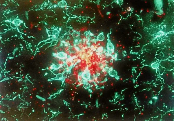 Placa de beta amiloide (rojo) y de microglía (verde).